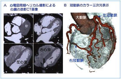 図４　心臓のマルチスライスCT