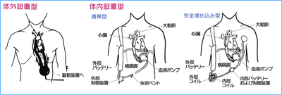 図2:人工心臓のタイプ