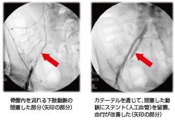 用語 医療 びっこ ひく