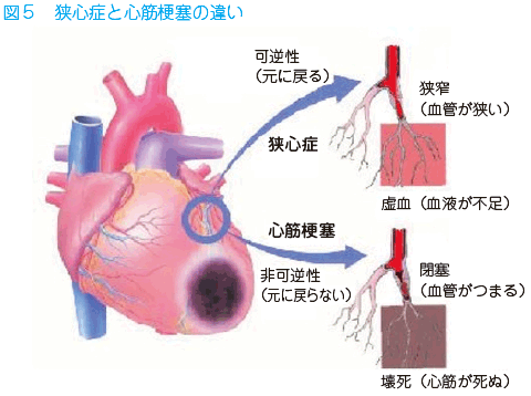 前兆 体験 梗塞 心筋