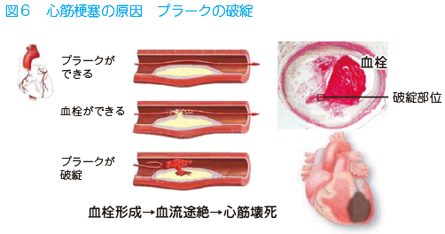 梗塞 心筋 心筋梗塞とは？原因・症状・治療・手術方法をわかりやすく解説｜ニューハート・ワタナベ国際病院