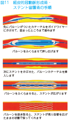 心筋 梗塞 カテーテル 手術