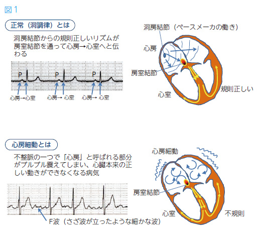 細 動 手術 心房