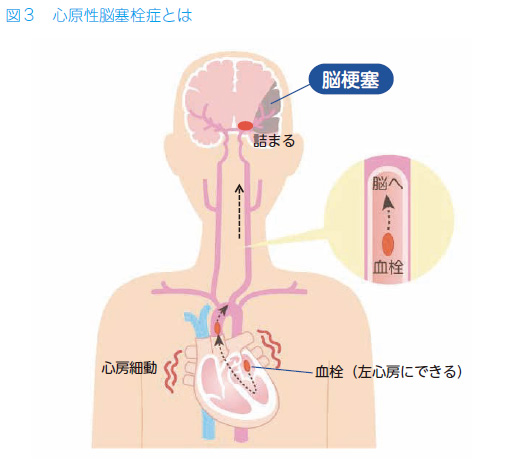 動 症状 細 心房 心房細動の原因と仕組み｜教えて！心房細動.com