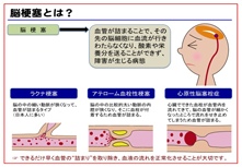 脳梗塞とは?