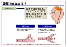 頭蓋内出血とは?