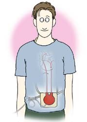 VASを装着している様子