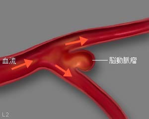 図４ 脳動脈瘤