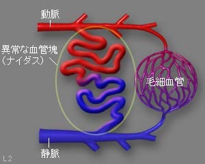 図８ 脳動静脈奇形の一例