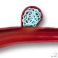 図１０ 脳動脈瘤コイル塞栓術の一例 c