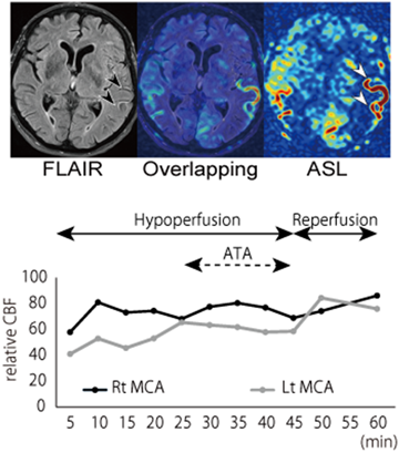 Repeated ASL perfusion images during intravenous thrombolysis