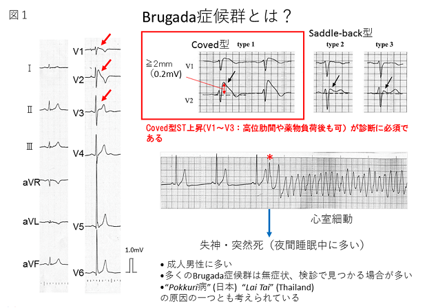 図1. Brugada症候群とは