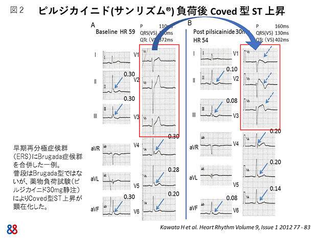 図2. ピルジカイニド（サンリズム）負荷後Coved型ST上昇