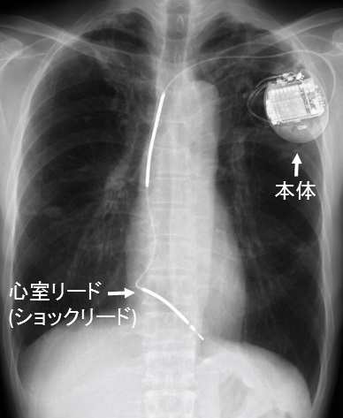 図2：経静脈植込み型除細動器(TV-ICD)