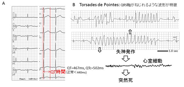 図１．先天性QT延長症候群の12誘導心電図(A)と多形性心室頻拍（Torsades de Pointes）