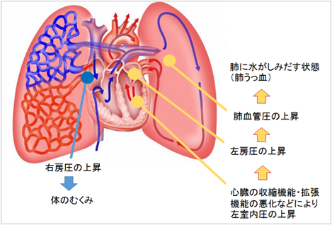 肺 に 水 が 溜まる 病気