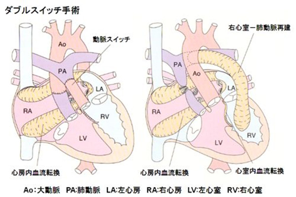 ダブルスイッチ手術