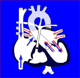 純型肺動脈閉鎖（PA/IVS）