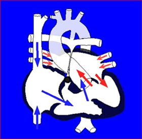 心室中隔欠損を伴う肺動脈閉鎖（PA/VSD）もしくはファロ－四徴症肺動脈閉鎖（TF/PA）