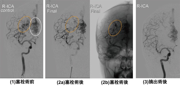 液体塞栓物質を用いた脳動静脈奇形の術前塞栓術の写真