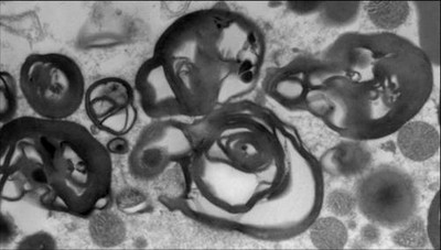 乾酪壊死 Caseous necrosis JapaneseClass.jp