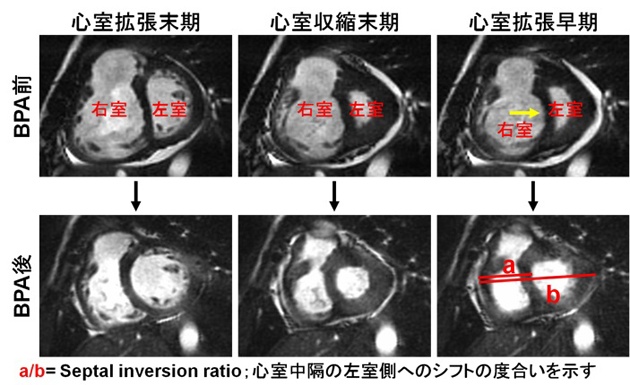 （写真）BPA前後の心臓MRI画像の比較