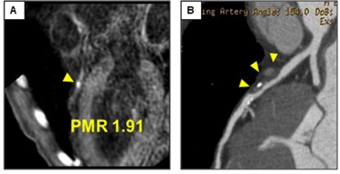 ＜図１＞冠動脈プラークをMRIとCTで撮影した画像