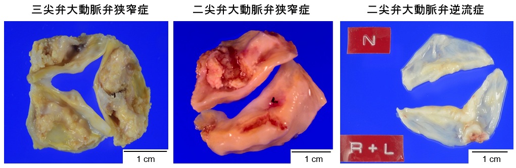 （図1）二尖弁大動脈弁狭窄症、二尖弁大動脈弁逆流症および三尖弁大動脈弁狭窄症の肉眼像