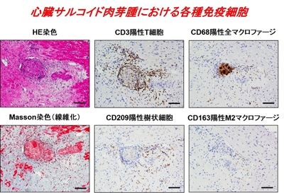 心臓サルコイド肉芽腫における各種免疫細胞