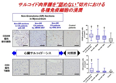 サルコイド肉芽腫を