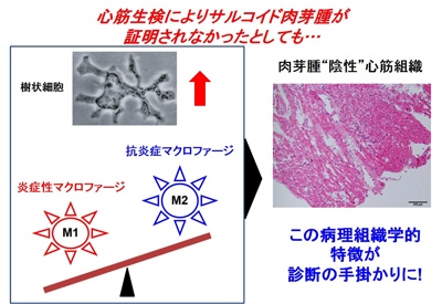 心筋生検によりサルコイド肉芽腫が証明されなかったとしても・・・