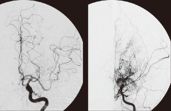 脳血管造営の画像
