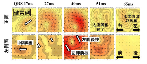 図1A 健常者の正面と左側面のマッピング(QRS)