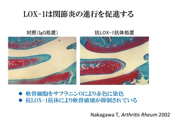 LOX-1は関節炎の進行を促進する 