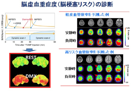 第４図　脳虚血重症度（脳梗塞リスク）の診断の例。安静時だけでなく脳血管拡張薬投与後の脳血流量を定量計測することで虚血の重症度すなわち脳梗塞発症のリスクが診断できる。