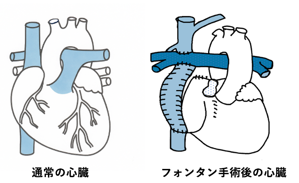 通常の心臓とフォンタン手術後の心臓