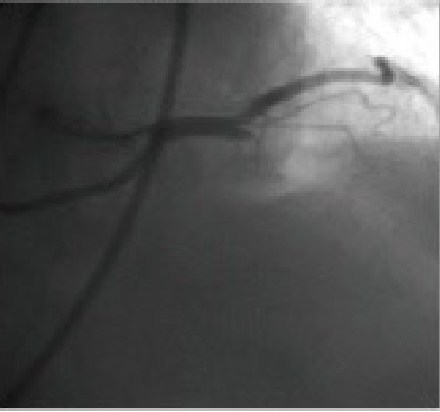 STEMI：初回造影