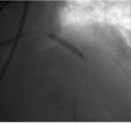 STEMI：ステント留置