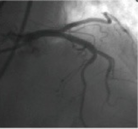 STEMI：再灌流療