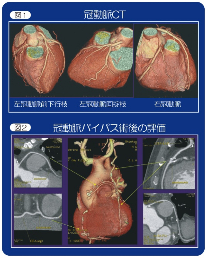 国循の冠動脈CT年間1500人以上が検査