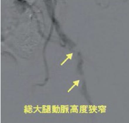 左総大腿動脈治療