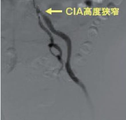 CIA治療