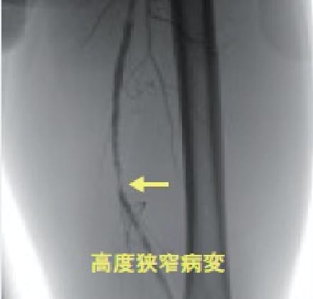 左浅大腿動脈治療