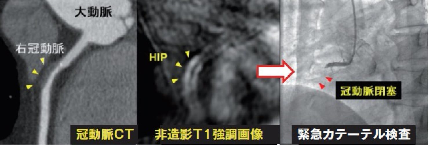 高信号プラーク（HIP）の部位で心筋梗塞を発症した