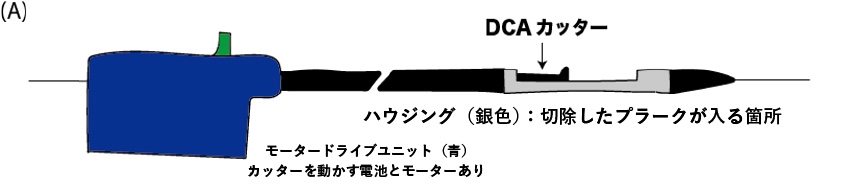 一方向性冠動脈アテレクトミー術(Directional coronary atherectomy: DCA)