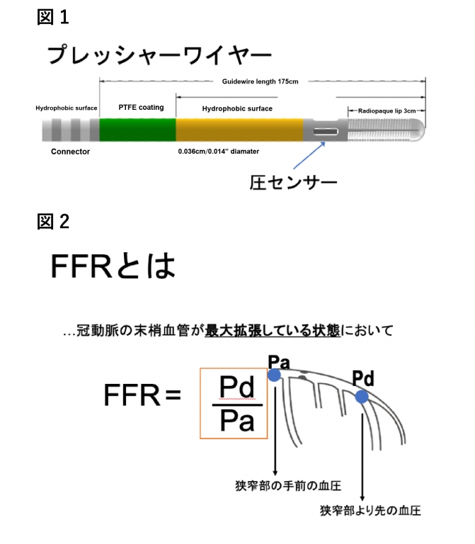 冠血流予備量比 (FFR) とは