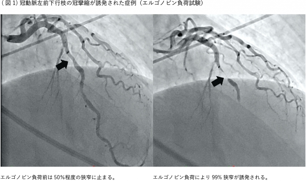 冠攣縮狭心症の原因 特徴 診断 治療法