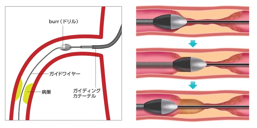 Orbital atherectomy(ダイヤモンドバック)のメカニズム