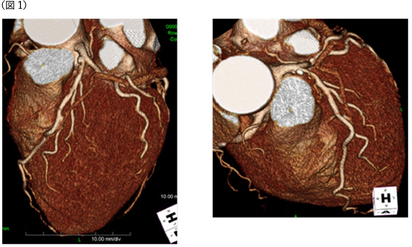 国循の冠動脈CT年間1500人以上が検査
