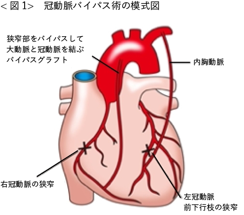 冠動脈バイパス術（CABG）とは？